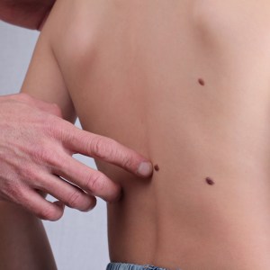 Skin Tag Removal Clinic in Lilburn Main, Lilburn Main Extension, Lilburn - Snellville, Norcross, Sandy Springs, Stone Mountain, Duluth, Clarkston, and Suwanee GA