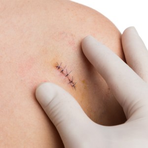 Suturing Clinic in Lilburn Main, Lilburn Main Extension, Lilburn - Snellville, Norcross, Sandy Springs, Stone Mountain, Duluth, Clarkston, and Suwanee GA
