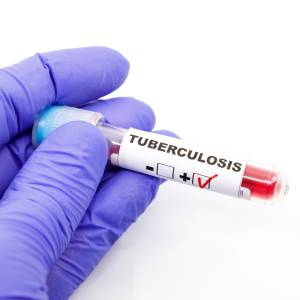 TB Screening in Lilburn Main, Lilburn Main Extension, Lilburn - Snellville, Norcross, Sandy Springs, Stone Mountain, Duluth, Clarkston, and Suwanee GA